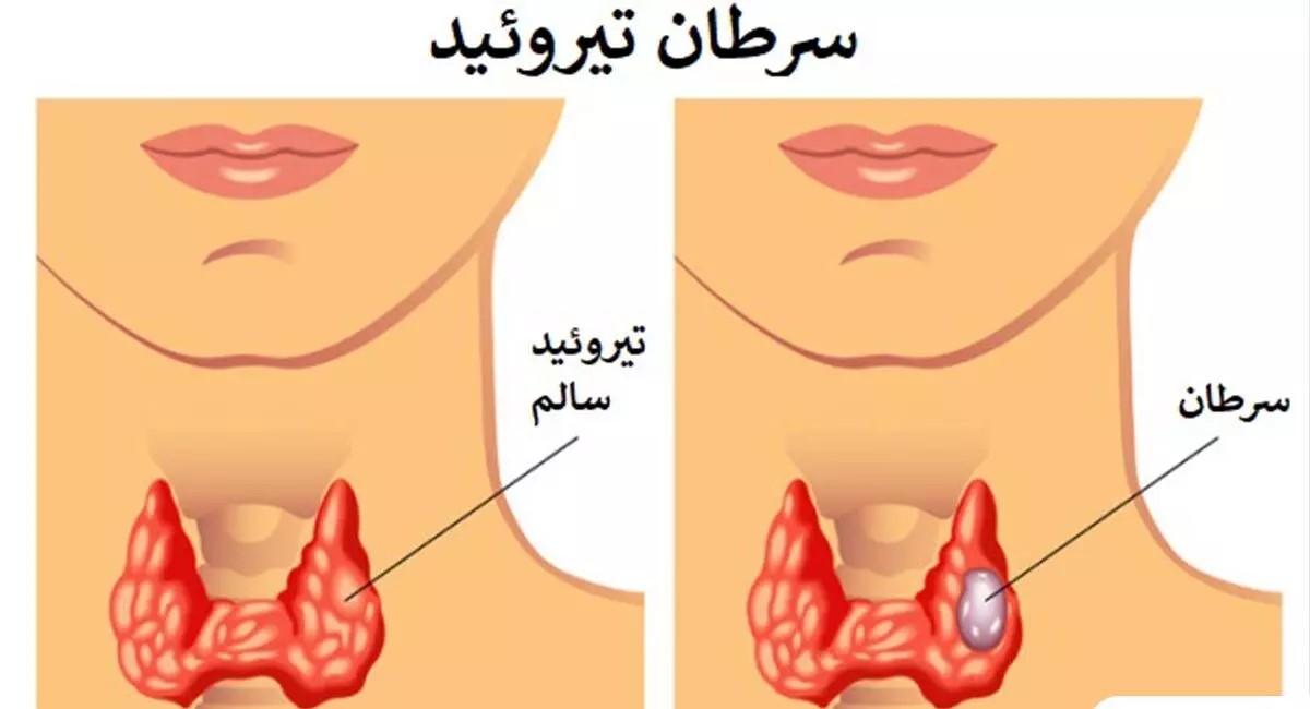 حقایق مهم درباره سرطان تیروئید | علائم خطرناک سرطان تیروئید