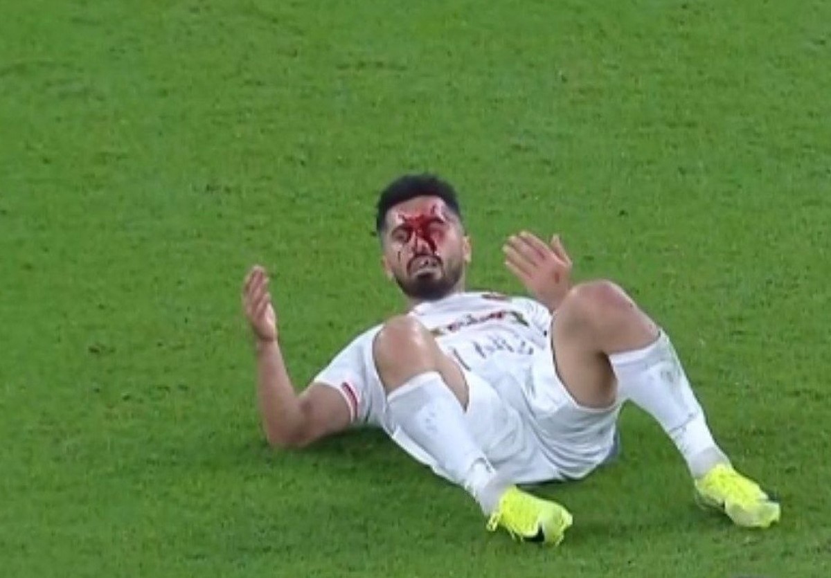 امید عالیشاه از بیمارستان مرخص شد| اولین تصویر از چشم کبود و زخم عمیق صورت امید عالیشاه