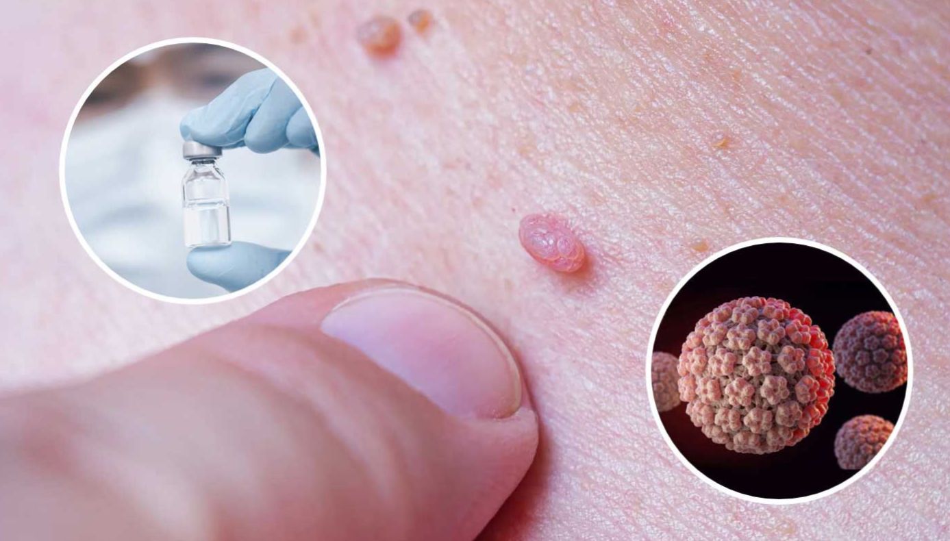 افزایش نگران‌کننده شیوع زگیل تناسلی در میان جوانان و نوجوانان کشورمان