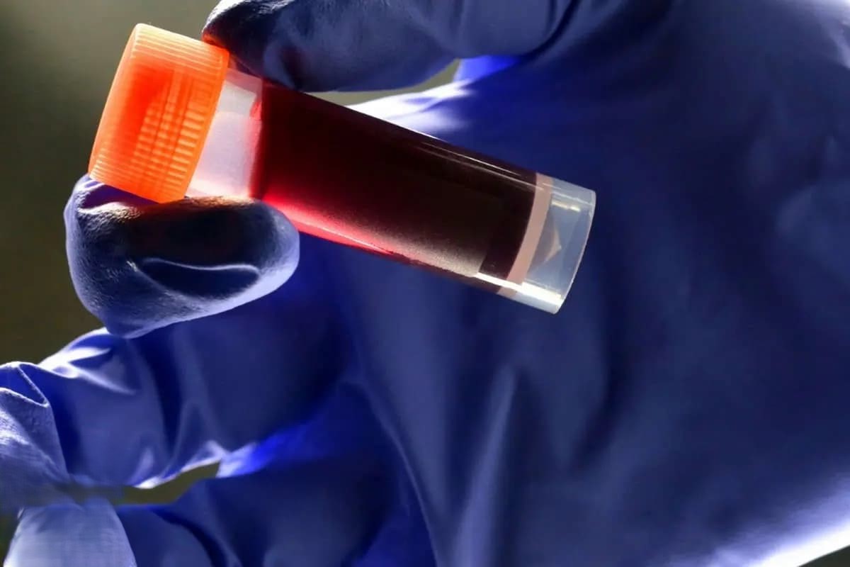 کدام گروه خونی بیشترین خطر سکته مغزی را دارد؟