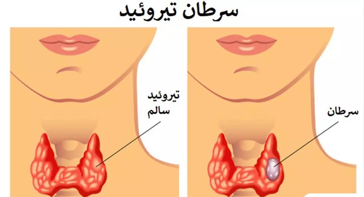 حقایق مهم درباره سرطان تیروئید | علائم خطرناک سرطان تیروئید
